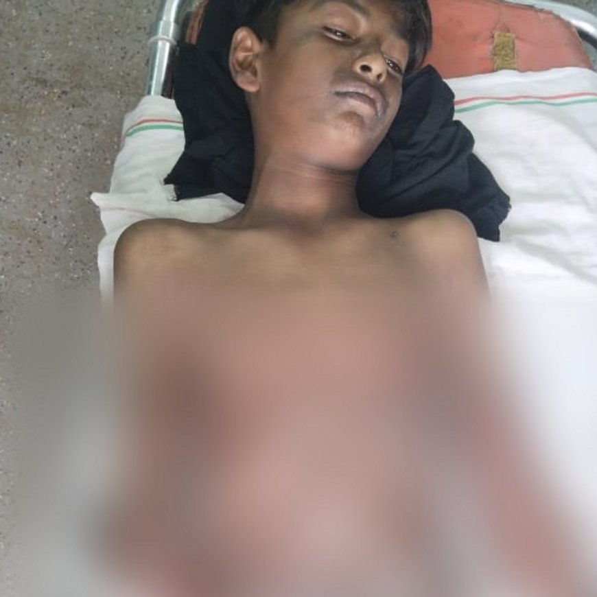 लखीमपुर में टोल प्लाजा पर किशोर पर हमला:पेट्रोल डालकर लगाई आग, शाहजहांपुर किया रेफर