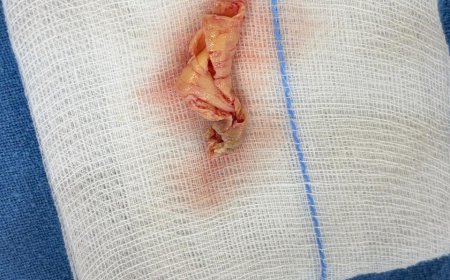 VELMED Hospital, Dehradun में स्ट्रोक से बचाव के लिए जटिल सर्जरी सफल