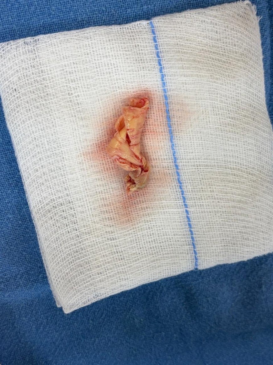 VELMED Hospital, Dehradun में स्ट्रोक से बचाव के लिए जटिल सर्जरी सफल